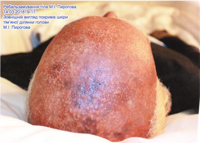 Фотографія. Ребальзамування тіла М.І.Пирогова. Перший етап. 14.03.2018. 9-17. Зовнішній вигляд покривів шкіри тім'яної ділянки голови М.І.Пирогова.